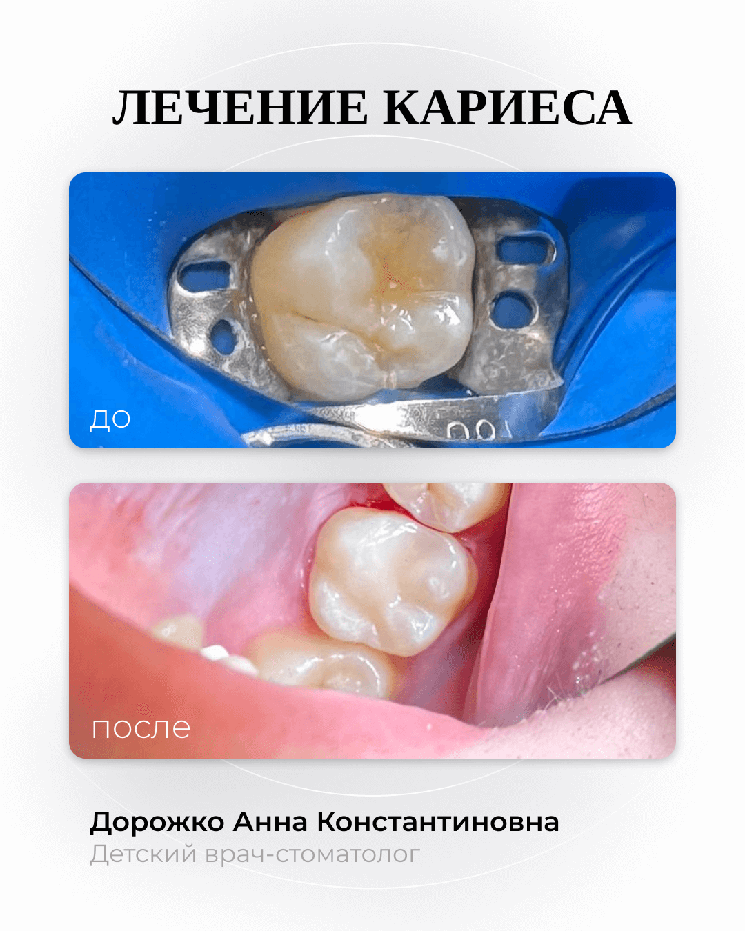 Лечение кариеса 16