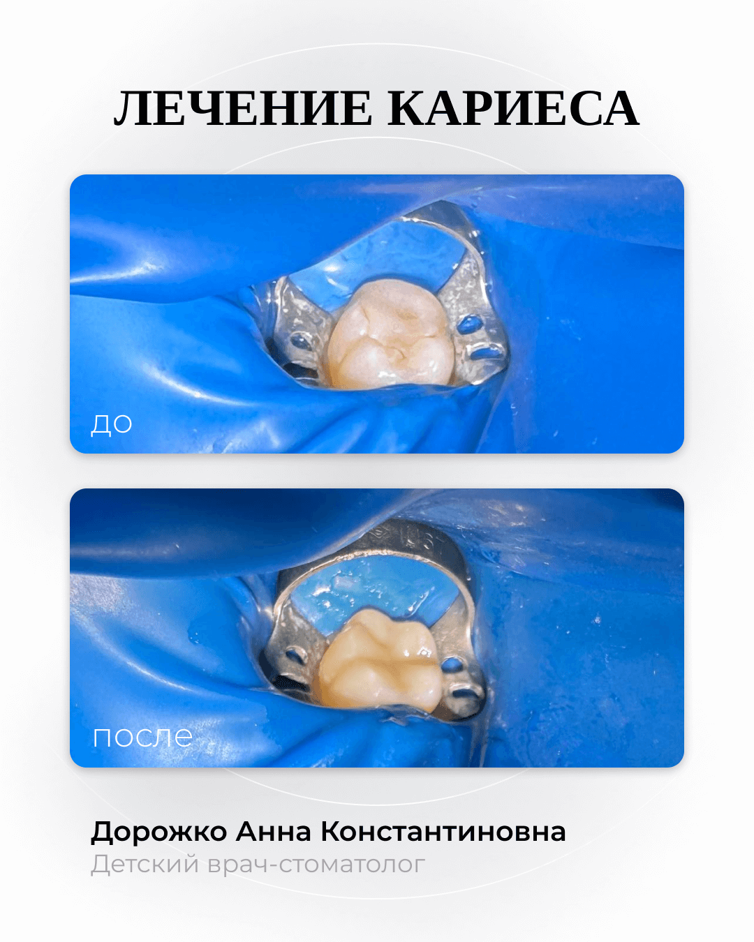 Лечение кариеса 46 вторичный