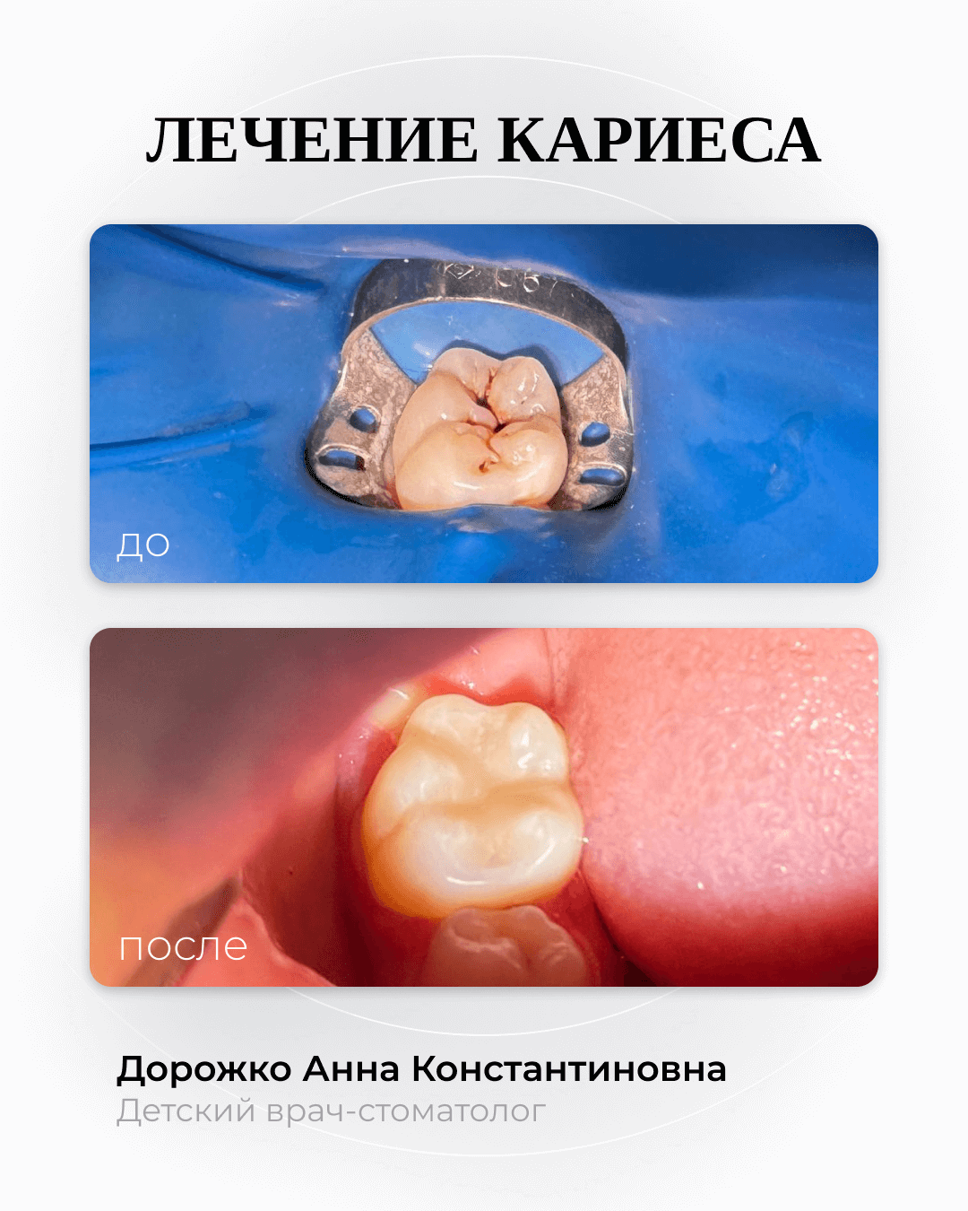 Лечение кариеса 46