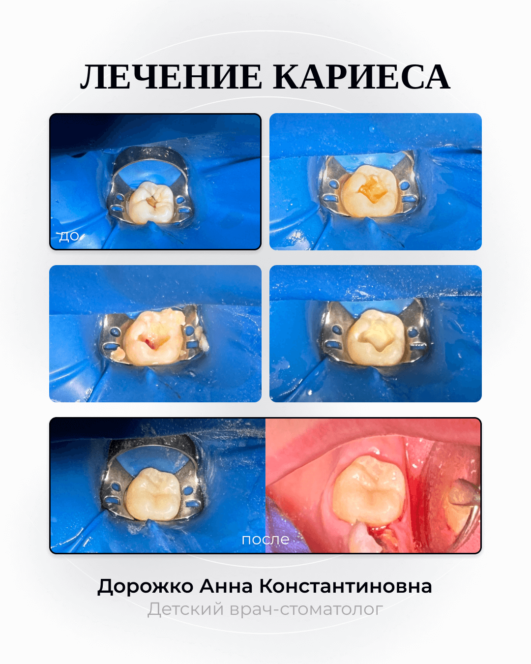 Лечение кариеса 49 Дорожко