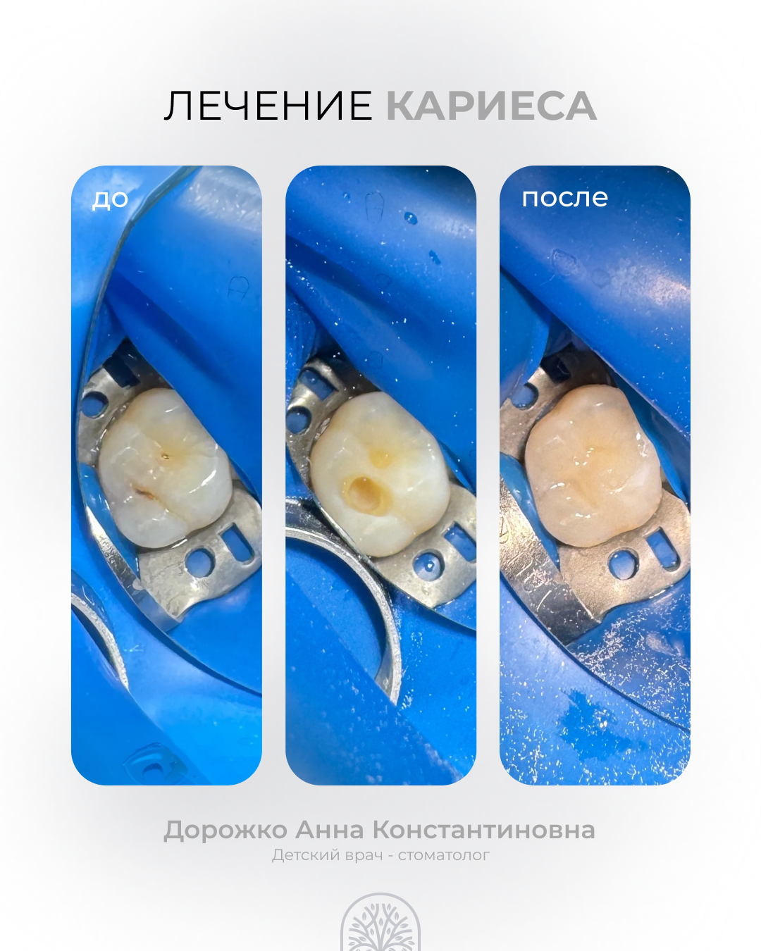 Лечение кариеса 57