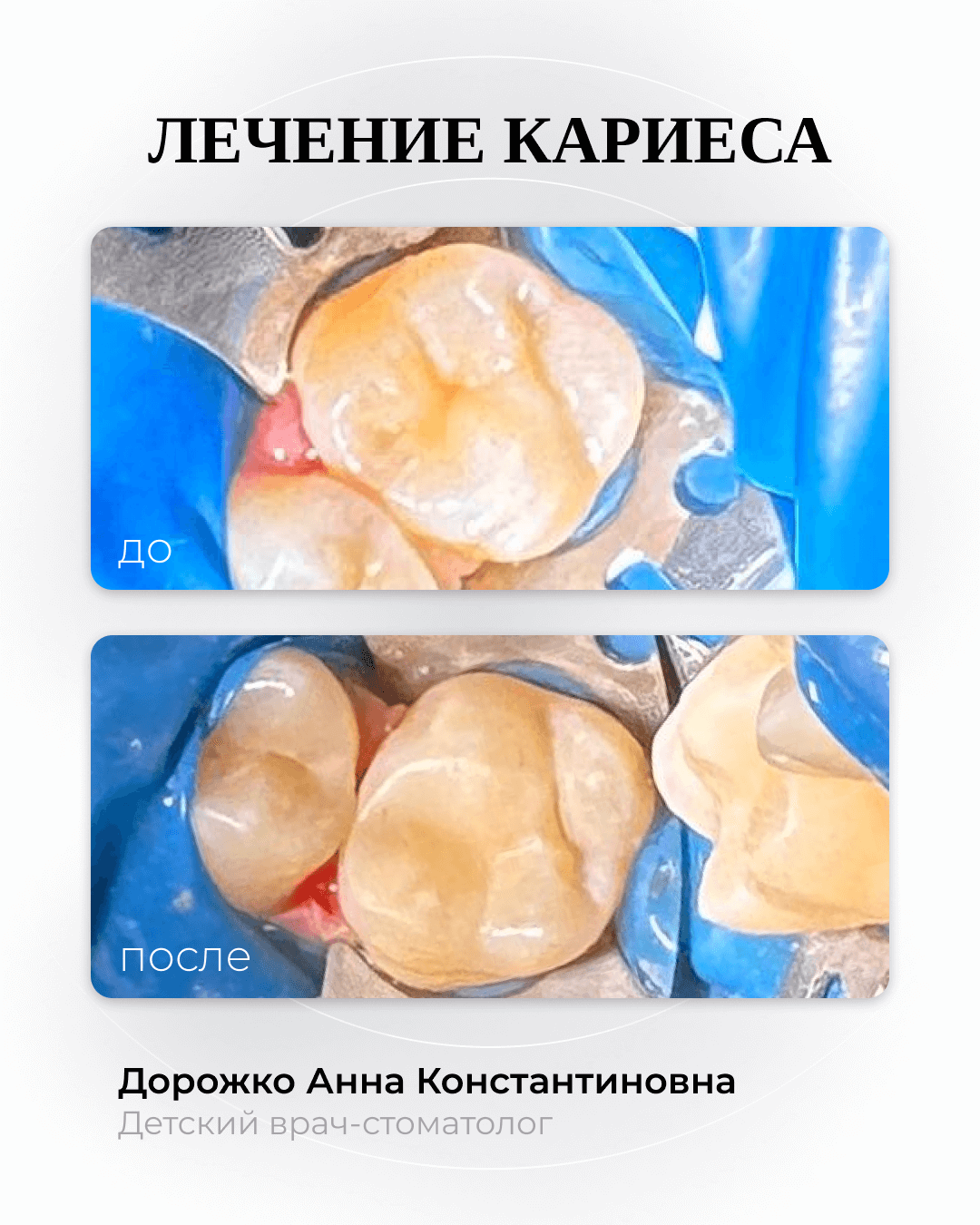 Лечение кариеса 6