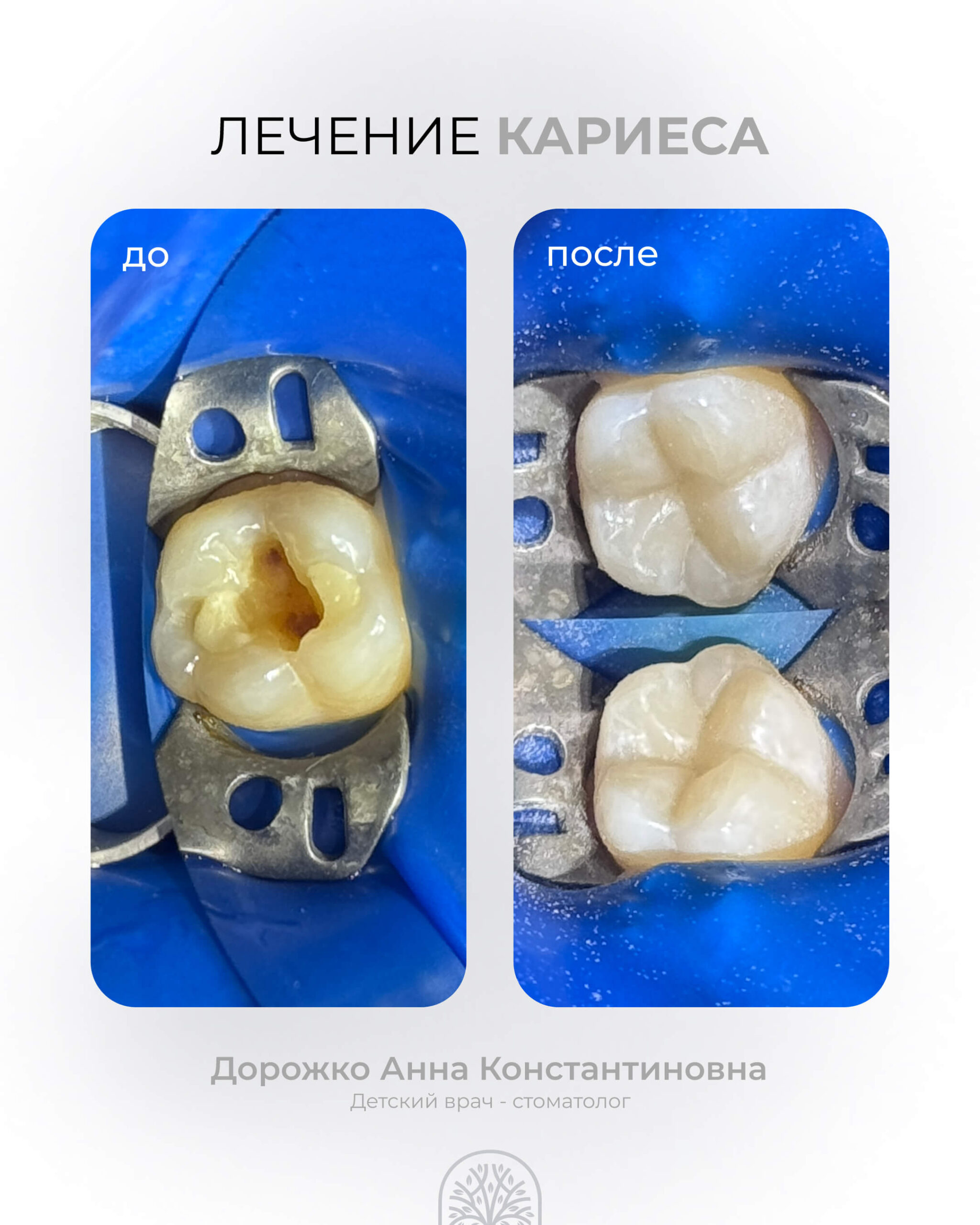 Лечение кариеса 801