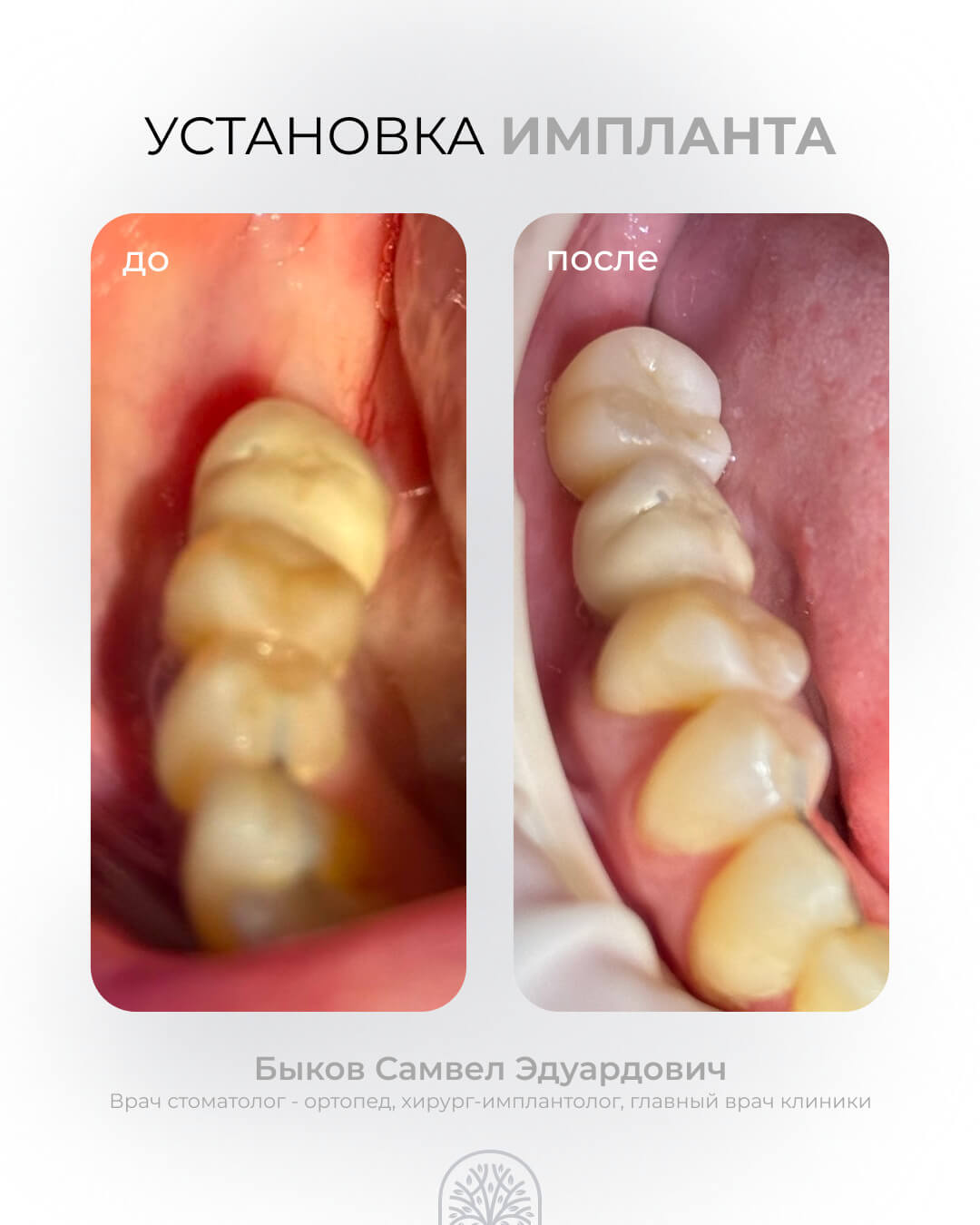 Установка импланта